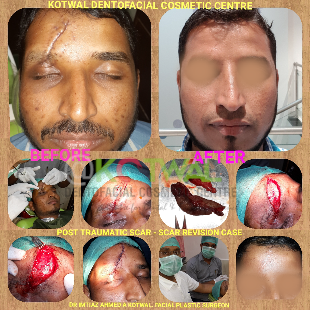 Post Traumatic Scar